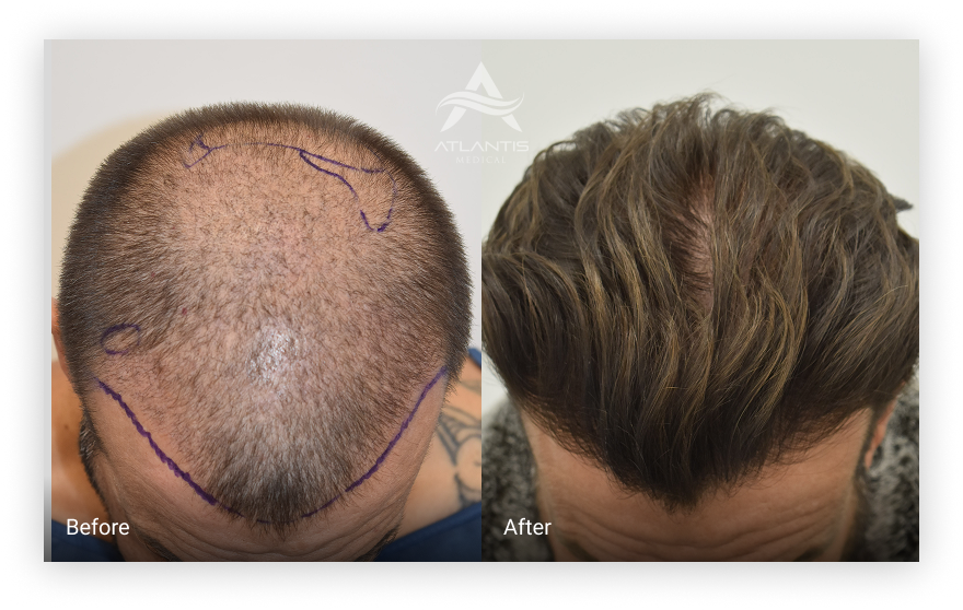 Before and after results of a hair restoration procedure performed at Atlantis Medical, showing significant hair growth and improved hairline