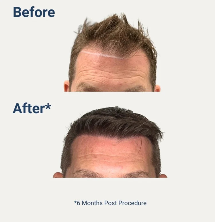 Before and after results by Follicle Hair Clinic